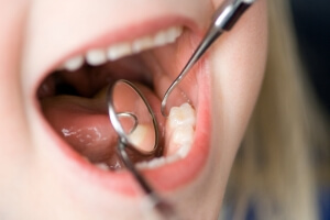 scraping plague from teeth